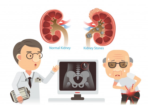 kidney stones illustration 99715 81