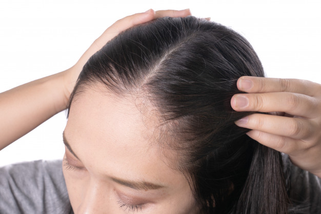 young asian women worry about problem hair loss head bald dandruff 9382 94