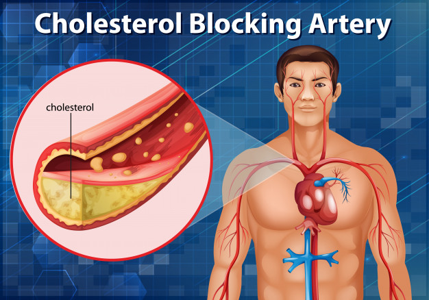 diagram showing cholesterol blocking artery human body 1308 43348