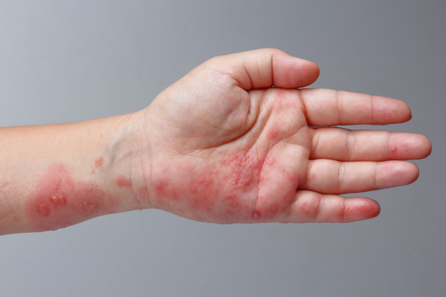 shingles zoster herpes zoster symptoms arm 176124 480