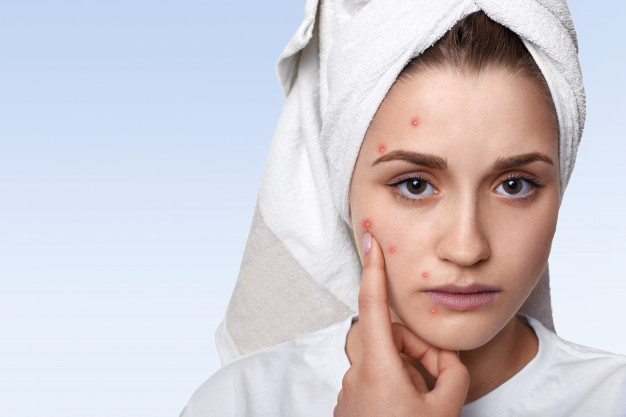portrait young woman having problem skin pimple her cheek wearing towel her head having sad expression pointing 176532 9979