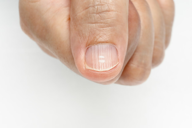 white spots vertical ridges fingernails symptoms deficiency vitamins minerals 176124 377